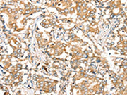 The image on the left is immunohistochemistry of paraffin-embedded Human liver cancer tissue using CSB-PA094289(SIRT4 Antibody) at dilution 1/35, on the right is treated with synthetic peptide. (Original magnification: ×200)