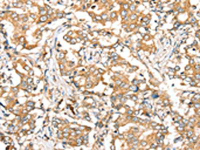The image on the left is immunohistochemistry of paraffin-embedded Human liver cancer tissue using CSB-PA094289(SIRT4 Antibody) at dilution 1/35, on the right is treated with synthetic peptide. (Original magnification: ×200)