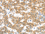 The image on the left is immunohistochemistry of paraffin-embedded Human cervical cancer tissue using CSB-PA094499(PTPN4 Antibody) at dilution 1/40, on the right is treated with synthetic peptide. (Original magnification: ×200)