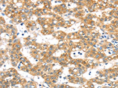 The image on the left is immunohistochemistry of paraffin-embedded Human cervical cancer tissue using CSB-PA094499(PTPN4 Antibody) at dilution 1/40, on the right is treated with synthetic peptide. (Original magnification: ×200)