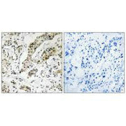 Immunohistochemistry analysis of paraffin-embedded human breast carcinoma tissue using TCEAL3/5/6 antibody.
