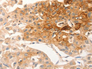 The image on the left is immunohistochemistry of paraffin-embedded Human lung cancer tissue using CSB-PA094529(CSF3R Antibody) at dilution 1/12, on the right is treated with synthetic peptide. (Original magnification: ×200)
