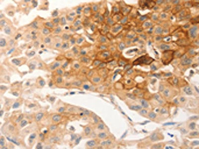 The image on the left is immunohistochemistry of paraffin-embedded Human lung cancer tissue using CSB-PA094529(CSF3R Antibody) at dilution 1/12, on the right is treated with synthetic peptide. (Original magnification: ×200)