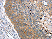 The image on the left is immunohistochemistry of paraffin-embedded Human esophagus cancer tissue using CSB-PA094733(REG3A Antibody) at dilution 1/40, on the right is treated with synthetic peptide. (Original magnification: ×200)