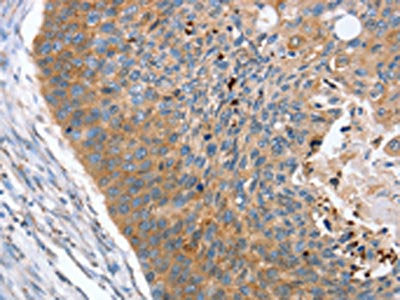The image on the left is immunohistochemistry of paraffin-embedded Human esophagus cancer tissue using CSB-PA094733(REG3A Antibody) at dilution 1/40, on the right is treated with synthetic peptide. (Original magnification: ×200)