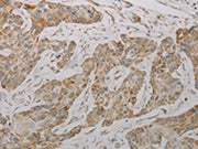 The image on the left is immunohistochemistry of paraffin-embedded Human esophagus cancer tissue using CSB-PA094894(TAC1 Antibody) at dilution 1/20, on the right is treated with synthetic peptide. (Original magnification: ×200)