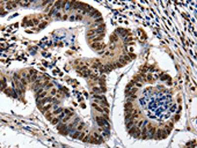 The image on the left is immunohistochemistry of paraffin-embedded Human colon cancer tissue using CSB-PA094965(KLK7 Antibody) at dilution 1/10, on the right is treated with fusion protein. (Original magnification: ×200)