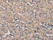 The image on the left is immunohistochemistry of paraffin-embedded Human liver cancer tissue using CSB-PA095524(SAMD9L Antibody) at dilution 1/30, on the right is treated with synthetic peptide. (Original magnification: ×200)