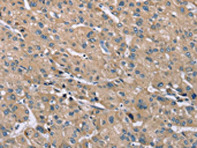The image on the left is immunohistochemistry of paraffin-embedded Human liver cancer tissue using CSB-PA095524(SAMD9L Antibody) at dilution 1/30, on the right is treated with synthetic peptide. (Original magnification: ×200)