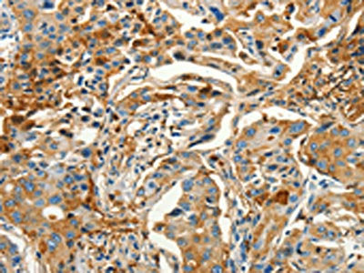 The image on the left is immunohistochemistry of paraffin-embedded Human lung cancer tissue using CSB-PA095703(CALCA Antibody) at dilution 1/60, on the right is treated with synthetic peptide. (Original magnification: ×200)