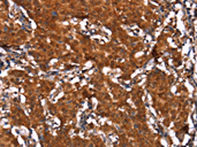 The image on the left is immunohistochemistry of paraffin-embedded Human gastic cancer tissue using CSB-PA095731(HCAR2 Antibody) at dilution 1/40, on the right is treated with synthetic peptide. (Original magnification: ×200)