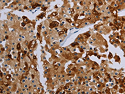 The image on the left is immunohistochemistry of paraffin-embedded Human prostate cancer tissue using CSB-PA095750(PDE4D Antibody) at dilution 1/20, on the right is treated with synthetic peptide. (Original magnification: ×200)