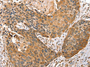 The image on the left is immunohistochemistry of paraffin-embedded Human esophagus cancer tissue using CSB-PA095978(STX10 Antibody) at dilution 1/45, on the right is treated with fusion protein. (Original magnification: ×200)