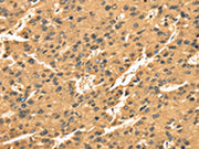 The image on the left is immunohistochemistry of paraffin-embedded Human liver cancer tissue using CSB-PA096801(TGM1 Antibody) at dilution 1/35, on the right is treated with synthetic peptide. (Original magnification: ×200)