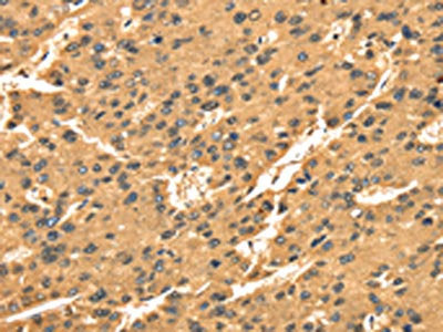 The image on the left is immunohistochemistry of paraffin-embedded Human liver cancer tissue using CSB-PA096801(TGM1 Antibody) at dilution 1/35, on the right is treated with synthetic peptide. (Original magnification: ×200)