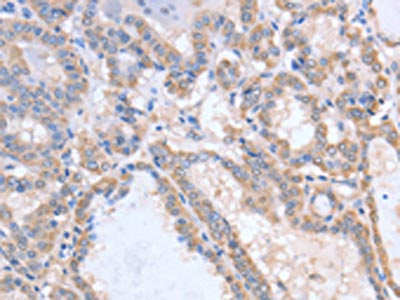 The image on the left is immunohistochemistry of paraffin-embedded Human thyroid cancer tissue using CSB-PA096831(ACVR1C Antibody) at dilution 1/15, on the right is treated with fusion protein. (Original magnification: ×200)