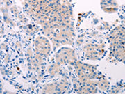 The image on the left is immunohistochemistry of paraffin-embedded Human lung cancer tissue using CSB-PA096932(TEKT4 Antibody) at dilution 1/10, on the right is treated with fusion protein. (Original magnification: ×200)