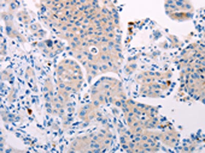 The image on the left is immunohistochemistry of paraffin-embedded Human lung cancer tissue using CSB-PA096932(TEKT4 Antibody) at dilution 1/10, on the right is treated with fusion protein. (Original magnification: ×200)