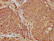 IHC image of CSB-PA09694A0Rb diluted at 1:90 and staining in paraffin-embedded human liver cancer performed on a Leica BondTM system. After dewaxing and hydration, antigen retrieval was mediated by high pressure in a citrate buffer (pH 6.0). Secti...
