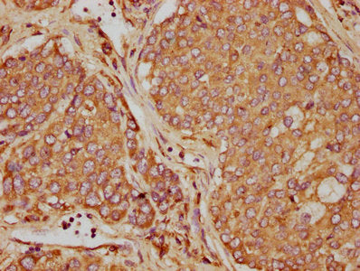 IHC image of CSB-PA09694A0Rb diluted at 1:90 and staining in paraffin-embedded human liver cancer performed on a Leica BondTM system. After dewaxing and hydration, antigen retrieval was mediated by high pressure in a citrate buffer (pH 6.0). Secti...