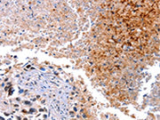 The image on the left is immunohistochemistry of paraffin-embedded Human lung cancer tissue using CSB-PA097056(HMOX1 Antibody) at dilution 1/40, on the right is treated with fusion protein. (Original magnification: ×200)