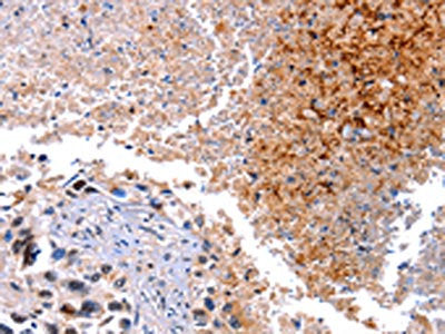 The image on the left is immunohistochemistry of paraffin-embedded Human lung cancer tissue using CSB-PA097056(HMOX1 Antibody) at dilution 1/40, on the right is treated with fusion protein. (Original magnification: ×200)