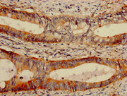 IHC image of CSB-PA09727A0Rb diluted at 1:1000 and staining in paraffin-embedded human colon cancer performed on a Leica BondTM system. After dewaxing and hydration, antigen retrieval was mediated by high pressure in a citrate buffer (pH 6.0). Sec...