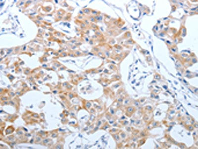 The image on the left is immunohistochemistry of paraffin-embedded Human lung cancer tissue using CSB-PA097333(CEACAM5 Antibody) at dilution 1/40, on the right is treated with synthetic peptide. (Original magnification: ×200)