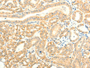 The image on the left is immunohistochemistry of paraffin-embedded Human thyroid cancer tissue using CSB-PA097438(TRAF6 Antibody) at dilution 1/15, on the right is treated with fusion protein. (Original magnification: ×200)
