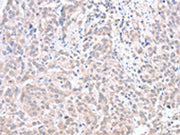 The image on the left is immunohistochemistry of paraffin-embedded Human esophagus cancer tissue using CSB-PA097487(ACOT1 Antibody) at dilution 1/30, on the right is treated with fusion protein. (Original magnification: ×200)