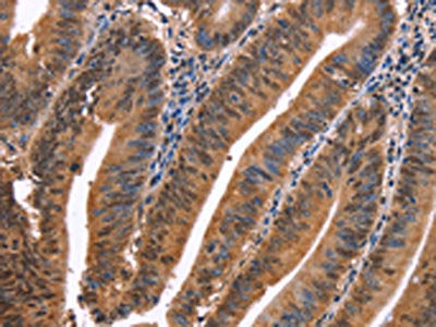 The image on the left is immunohistochemistry of paraffin-embedded Human colon cancer tissue using CSB-PA097491(EVC2 Antibody) at dilution 1/40, on the right is treated with synthetic peptide. (Original magnification: ×200)