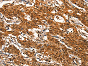 The image on the left is immunohistochemistry of paraffin-embedded Human gastic cancer tissue using CSB-PA097710(DEAF1 Antibody) at dilution 1/40, on the right is treated with synthetic peptide. (Original magnification: ×200)