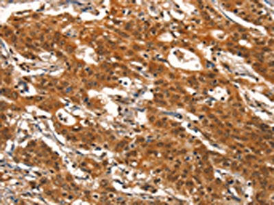 The image on the left is immunohistochemistry of paraffin-embedded Human gastic cancer tissue using CSB-PA097710(DEAF1 Antibody) at dilution 1/40, on the right is treated with synthetic peptide. (Original magnification: ×200)