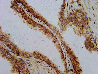 IHC image of CSB-PA09774A0Rb diluted at 1:700 and staining in paraffin-embedded human prostate cancer performed on a Leica BondTM system. After dewaxing and hydration, antigen retrieval was mediated by high pressure in a citrate buffer (pH 6.0). S...