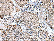 The image on the left is immunohistochemistry of paraffin-embedded Human breast cancer tissue using CSB-PA097823(WDR5 Antibody) at dilution 1/20, on the right is treated with fusion protein. (Original magnification: ×200)