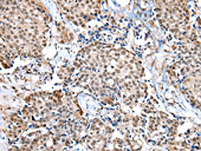 The image on the left is immunohistochemistry of paraffin-embedded Human breast cancer tissue using CSB-PA097823(WDR5 Antibody) at dilution 1/20, on the right is treated with fusion protein. (Original magnification: ×200)