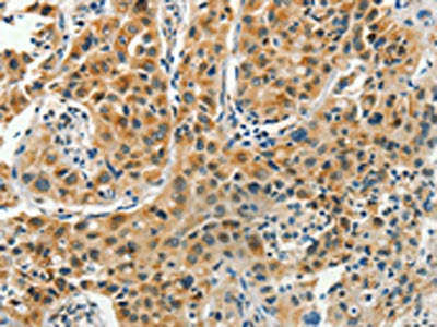 The image on the left is immunohistochemistry of paraffin-embedded Human lung cancer tissue using CSB-PA097824(PFDN6 Antibody) at dilution 1/35, on the right is treated with synthetic peptide. (Original magnification: ×200)