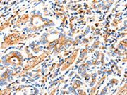 The image on the left is immunohistochemistry of paraffin-embedded Human gastic cancer tissue using CSB-PA097880(MAP2K2 Antibody) at dilution 1/100, on the right is treated with synthetic peptide. (Original magnification: ×200)