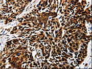 The image is immunohistochemistry of paraffin-embedded Human esophagus cancer tissue using CSB-PA098004(AKT1 Antibody) at dilution 1/25. (Original magnification: ×200)