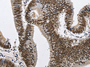 The image on the left is immunohistochemistry of paraffin-embedded Human colon cancer tissue using CSB-PA098010(CMTM2 Antibody) at dilution 1/60, on the right is treated with fusion protein. (Original magnification: ×200)