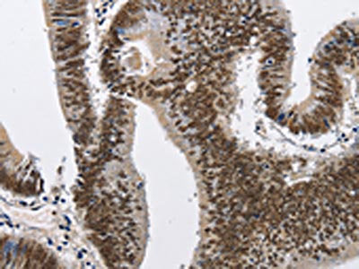 The image on the left is immunohistochemistry of paraffin-embedded Human colon cancer tissue using CSB-PA098010(CMTM2 Antibody) at dilution 1/60, on the right is treated with fusion protein. (Original magnification: ×200)