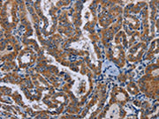 The image on the left is immunohistochemistry of paraffin-embedded Human thyroid cancer tissue using CSB-PA098019(LYN Antibody) at dilution 1/20, on the right is treated with fusion protein. (Original magnification: ×200)