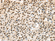The image on the left is immunohistochemistry of paraffin-embedded Human breast cancer tissue using CSB-PA098218(UBA1 Antibody) at dilution 1/40, on the right is treated with synthetic peptide. (Original magnification: ×200)