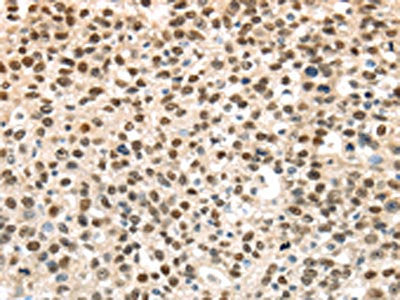 The image on the left is immunohistochemistry of paraffin-embedded Human breast cancer tissue using CSB-PA098218(UBA1 Antibody) at dilution 1/40, on the right is treated with synthetic peptide. (Original magnification: ×200)