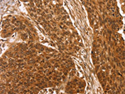The image on the left is immunohistochemistry of paraffin-embedded Human esophagus cancer tissue using CSB-PA098232(CCND2 Antibody) at dilution 1/25, on the right is treated with synthetic peptide. (Original magnification: ×200)