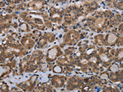 The image on the left is immunohistochemistry of paraffin-embedded Human thyroid cancer tissue using CSB-PA098234(MTSS1 Antibody) at dilution 1/20, on the right is treated with synthetic peptide. (Original magnification: ×200)