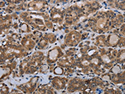 The image on the left is immunohistochemistry of paraffin-embedded Human thyroid cancer tissue using CSB-PA098234(MTSS1 Antibody) at dilution 1/20, on the right is treated with synthetic peptide. (Original magnification: ×200)