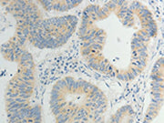 The image on the left is immunohistochemistry of paraffin-embedded Human gastic cancer tissue using CSB-PA098252(TP53BP2 Antibody) at dilution 1/5, on the right is treated with synthetic peptide. (Original magnification: ×200)