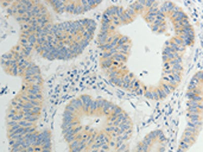 The image on the left is immunohistochemistry of paraffin-embedded Human gastic cancer tissue using CSB-PA098252(TP53BP2 Antibody) at dilution 1/5, on the right is treated with synthetic peptide. (Original magnification: ×200)
