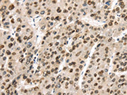 The image on the left is immunohistochemistry of paraffin-embedded Human liver cancer tissue using CSB-PA098304(TUSC5 Antibody) at dilution 1/40, on the right is treated with synthetic peptide. (Original magnification: ×200)